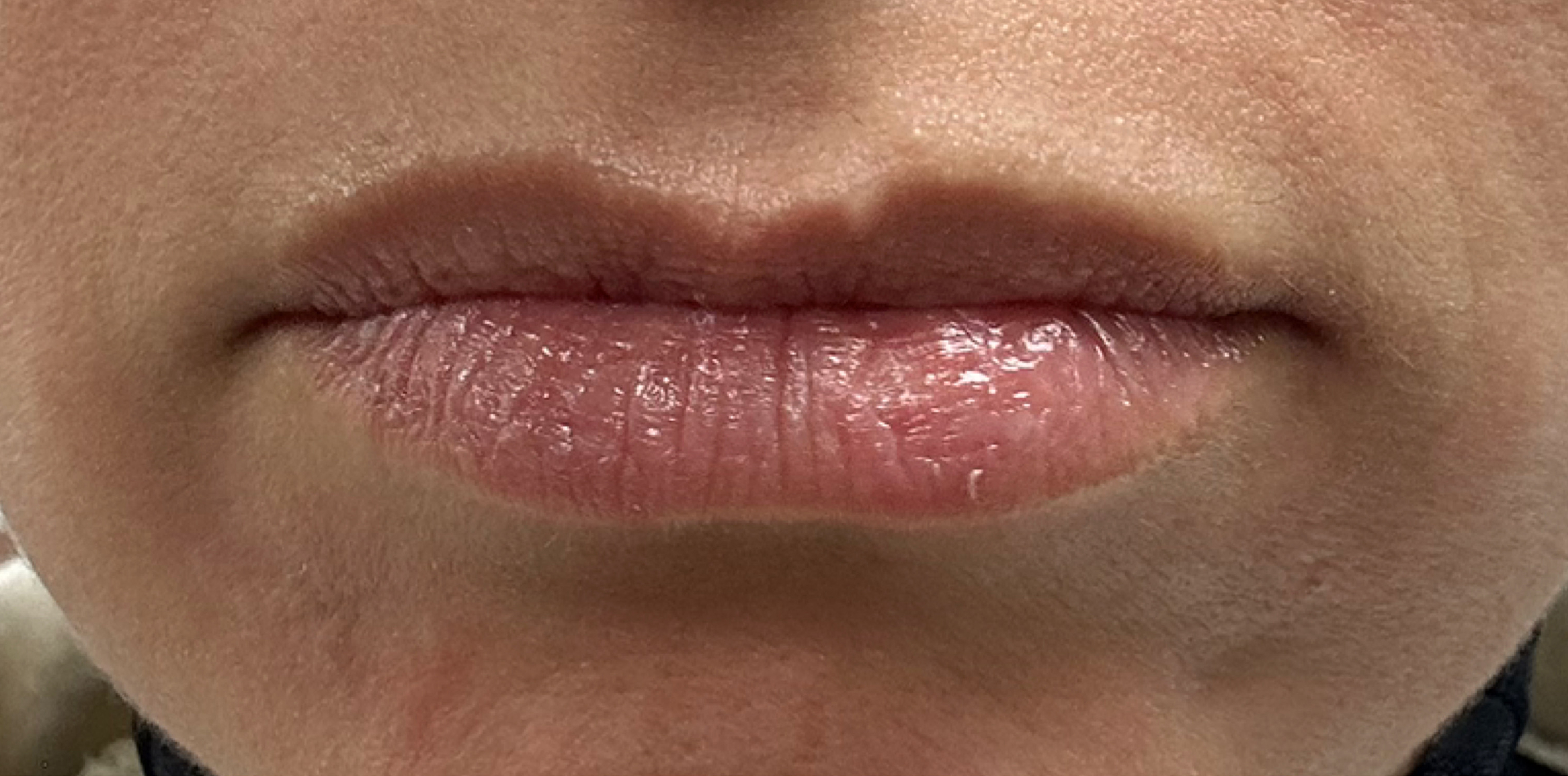 Foto Rejuv. Laser Antes 1