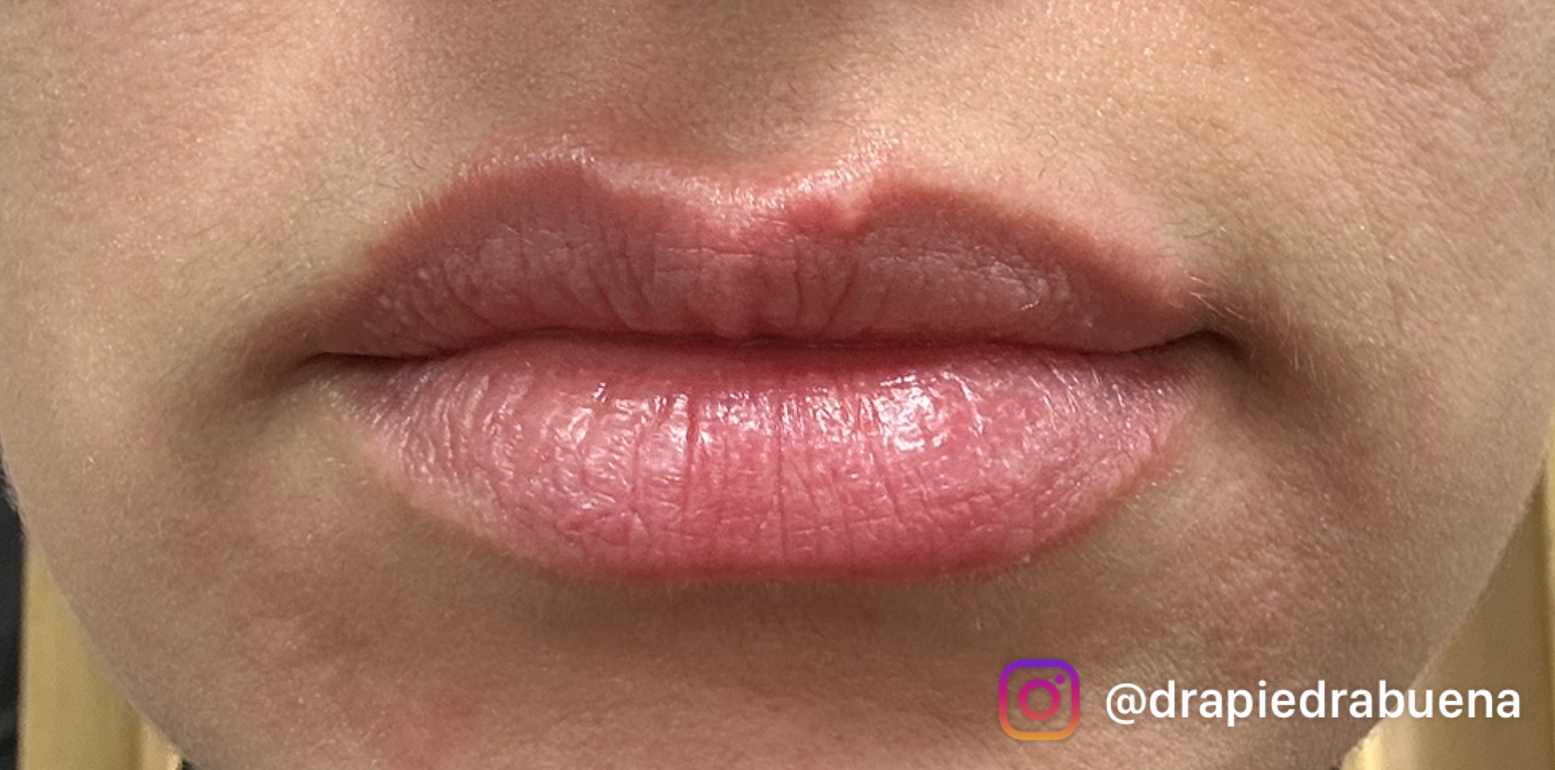 Foto Rejuv. Laser Despues 1