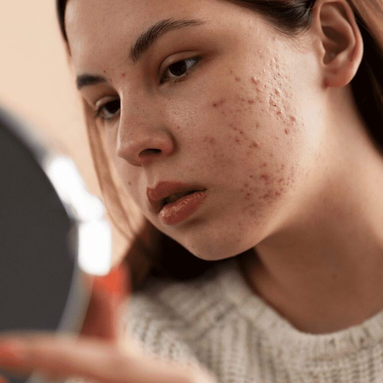 Tratamiento de acné